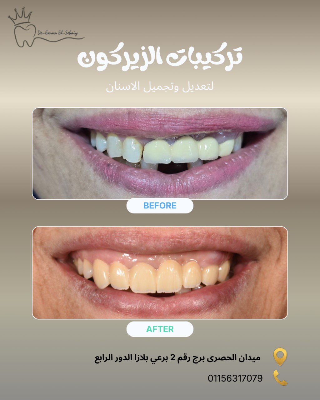 تركيبات الزيركون