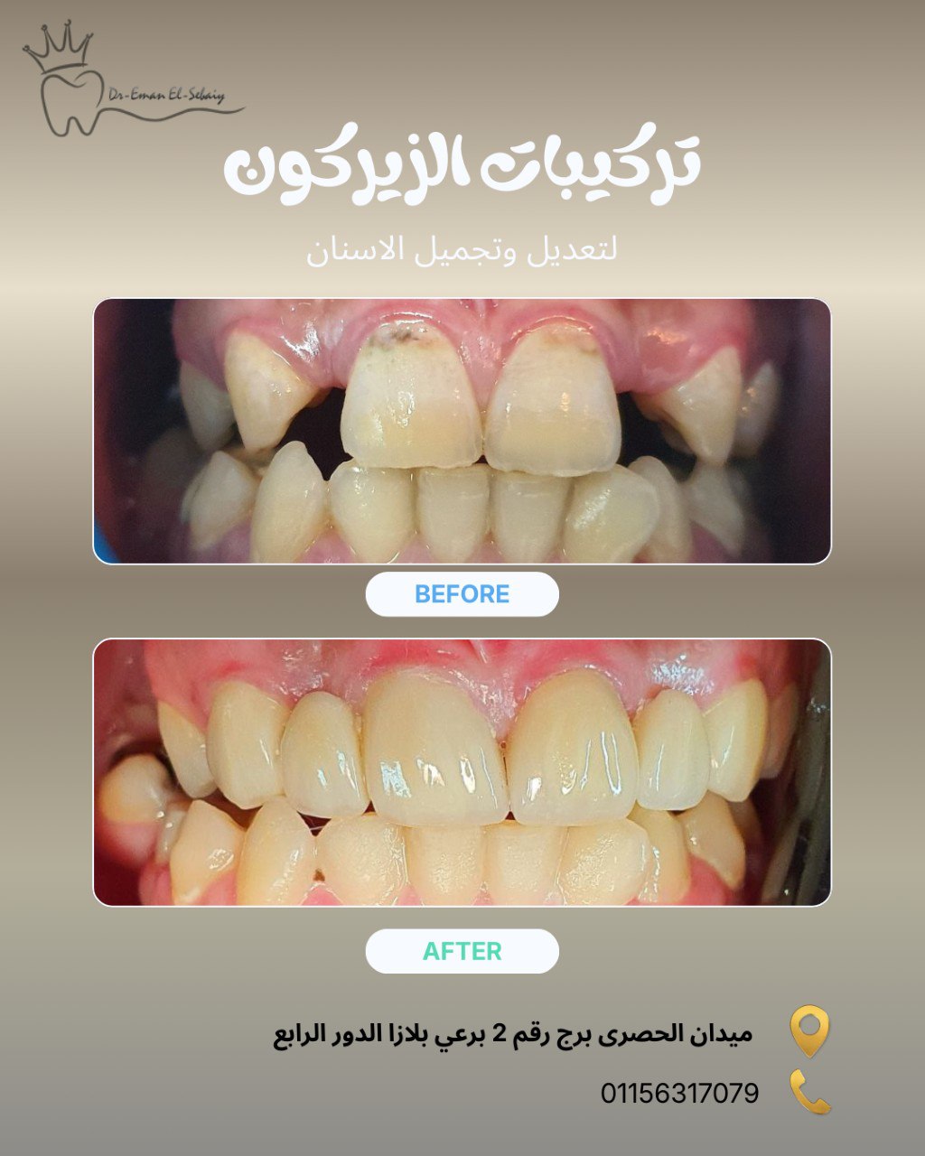 تركيبات الزيركون