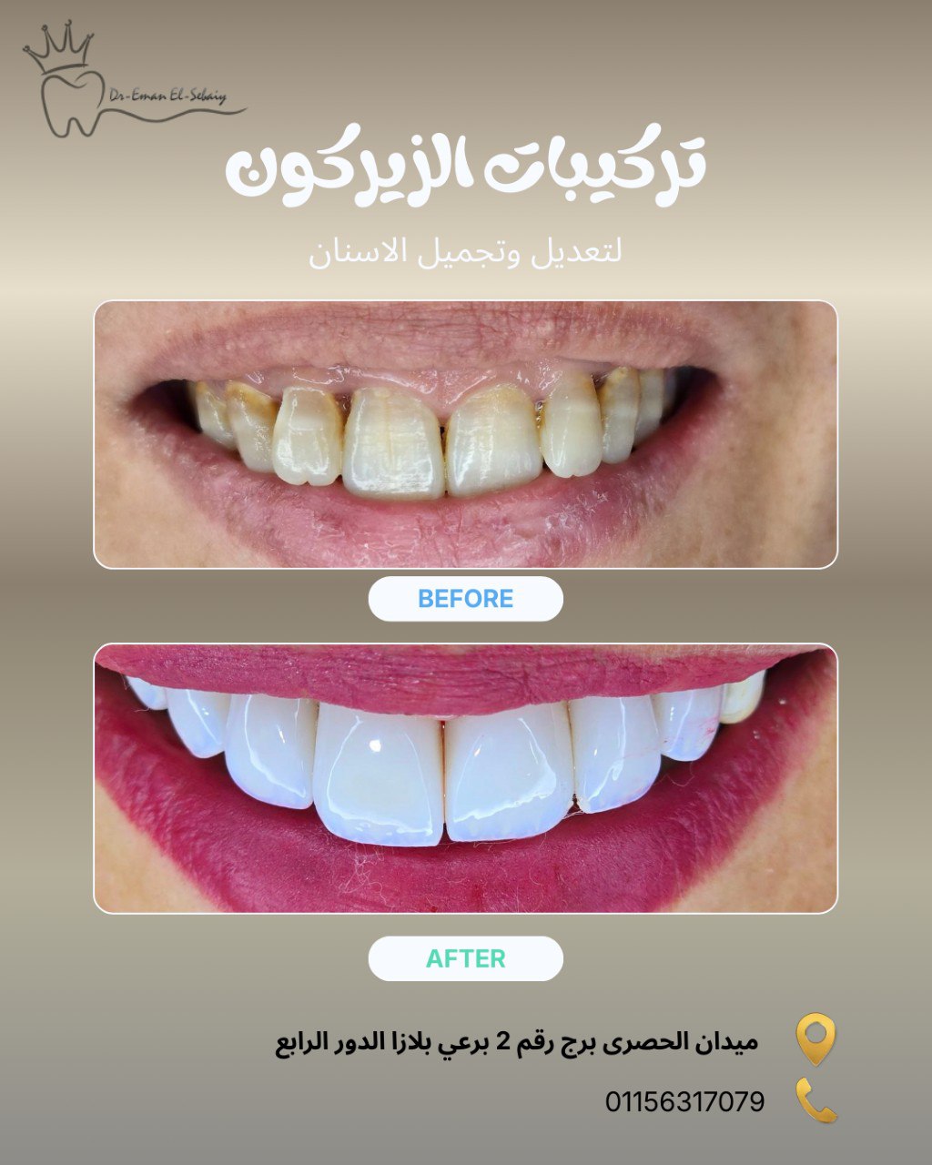تركيبات الزيركون