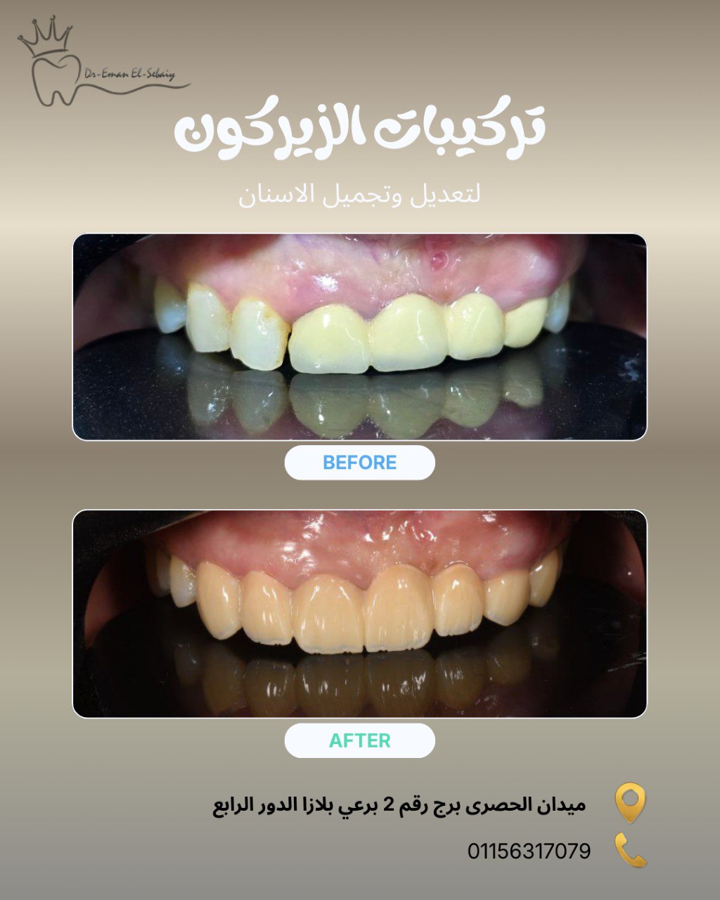 تركيبات الزيركون