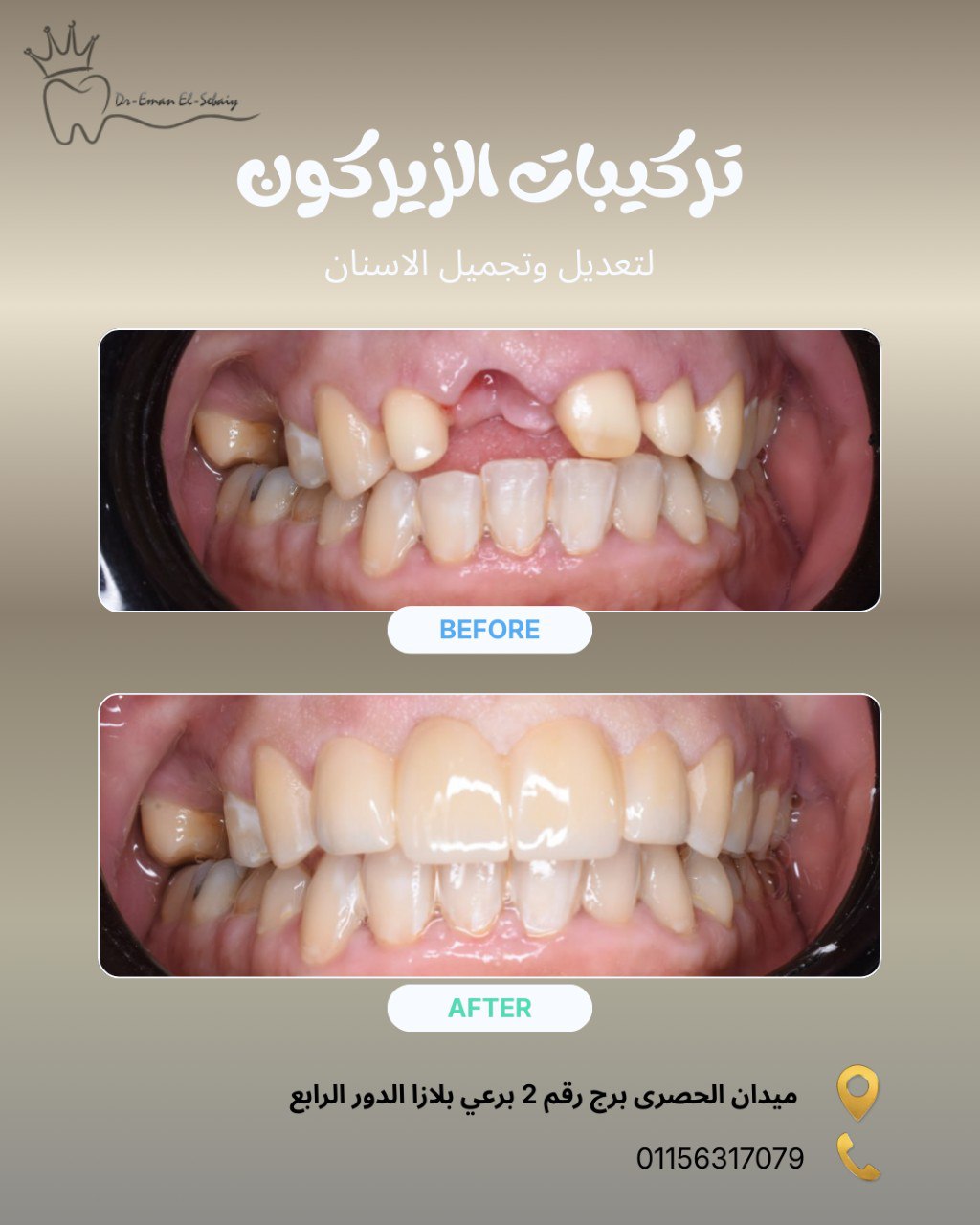 تركيبات الزيركون