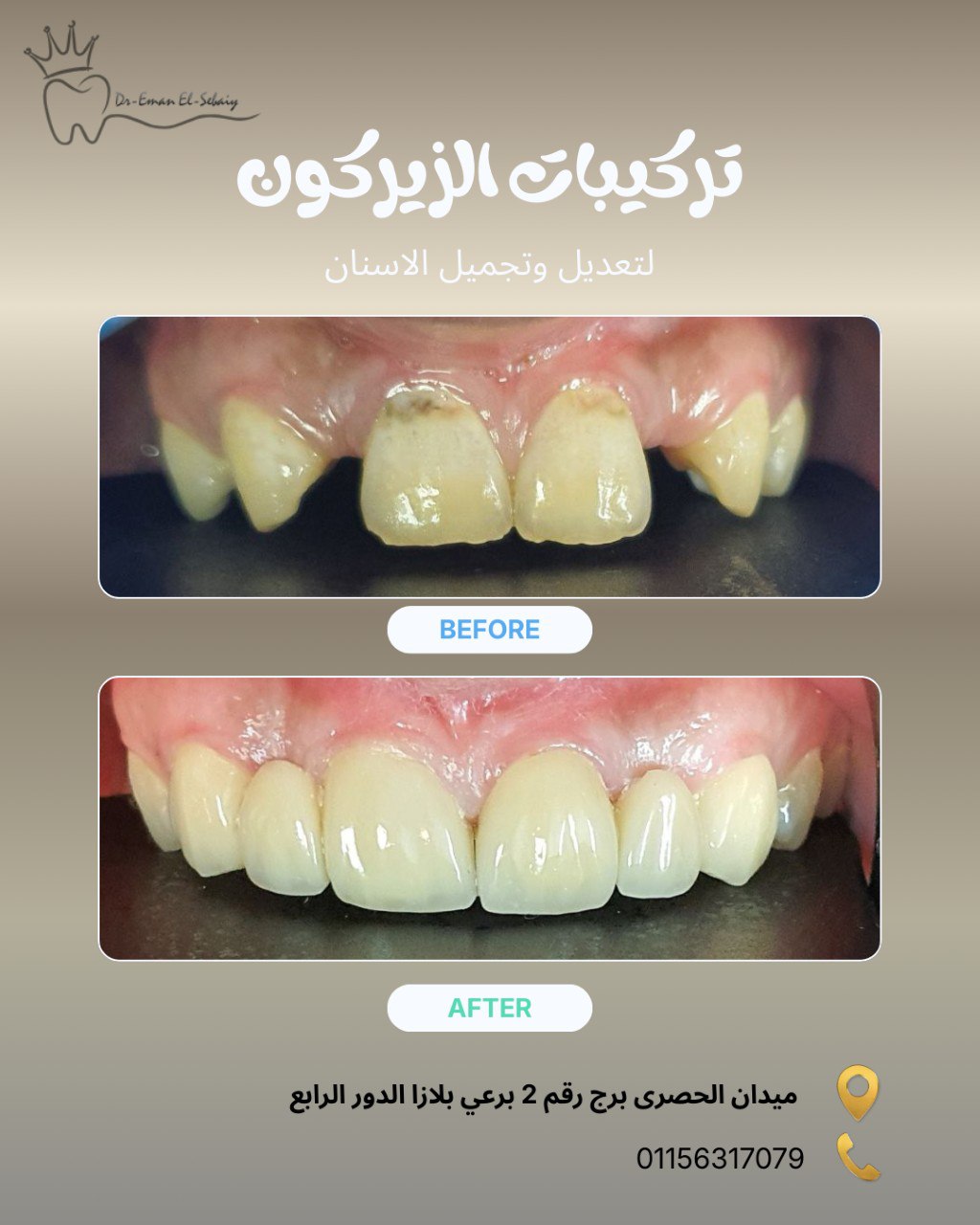 تركيبات الزيركون