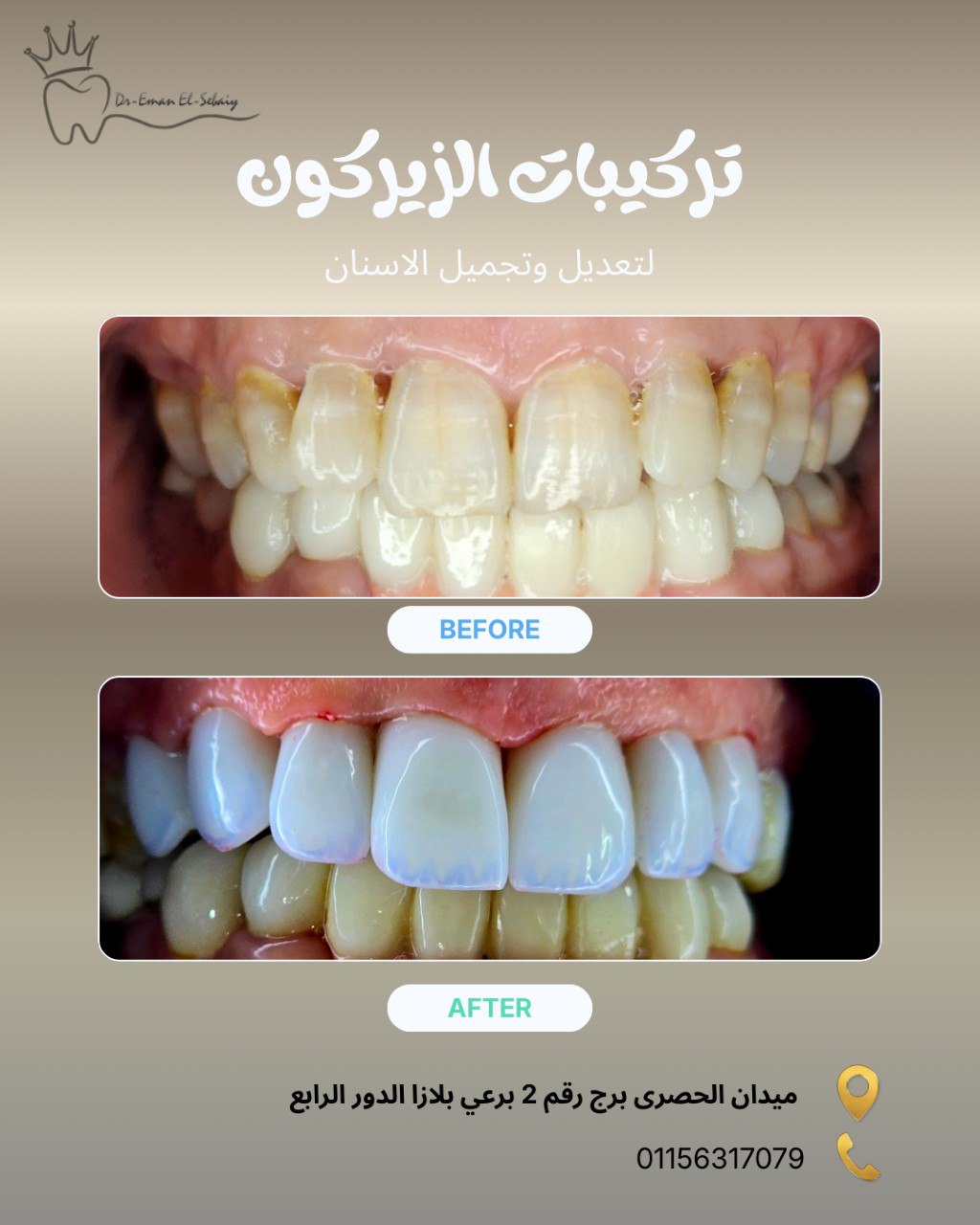 تركيبات الزيركون