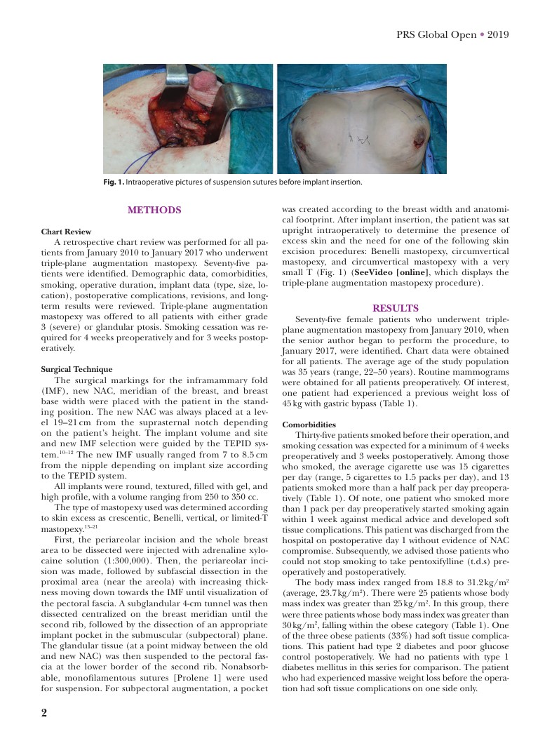 Triple-Plane Augmentation Mastopexy - Page 2