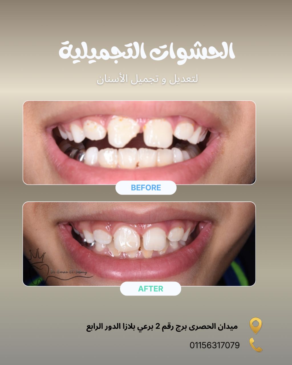 حشوات تجميلية