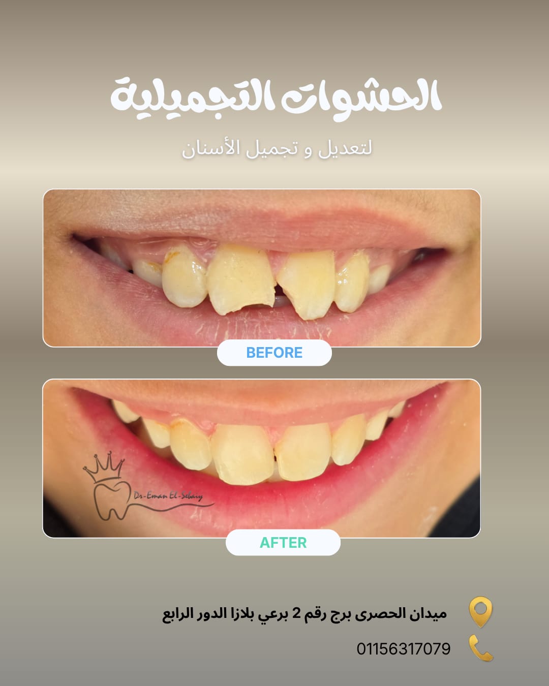 حشوات تجميلية