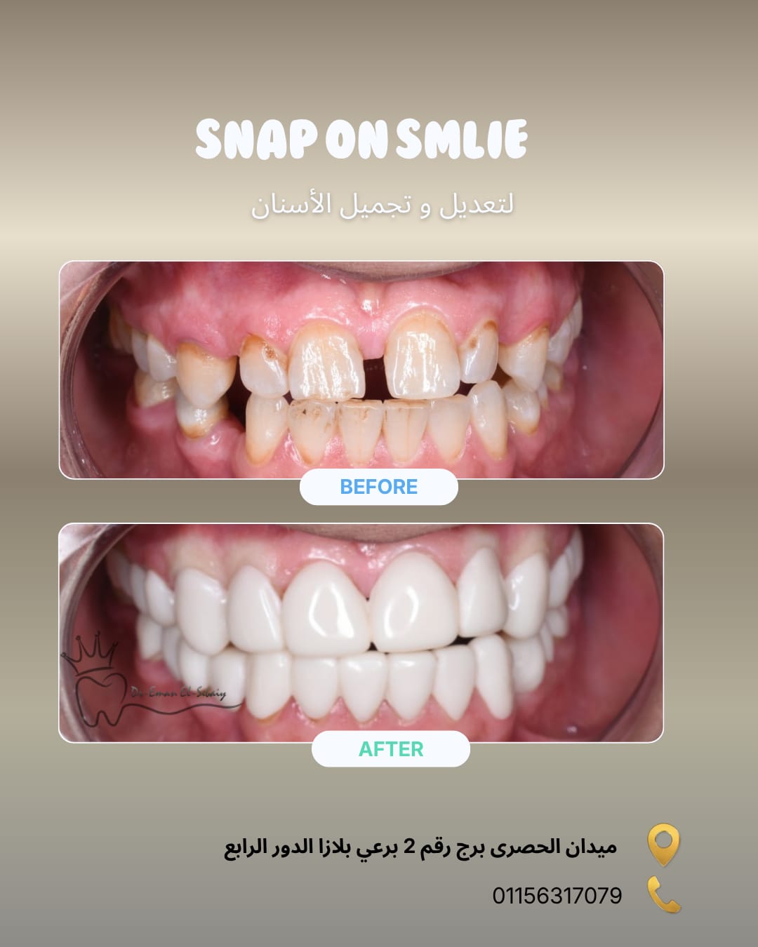 Snap On Smile