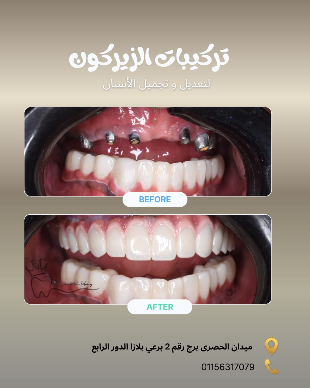 تركيبات الزيركون