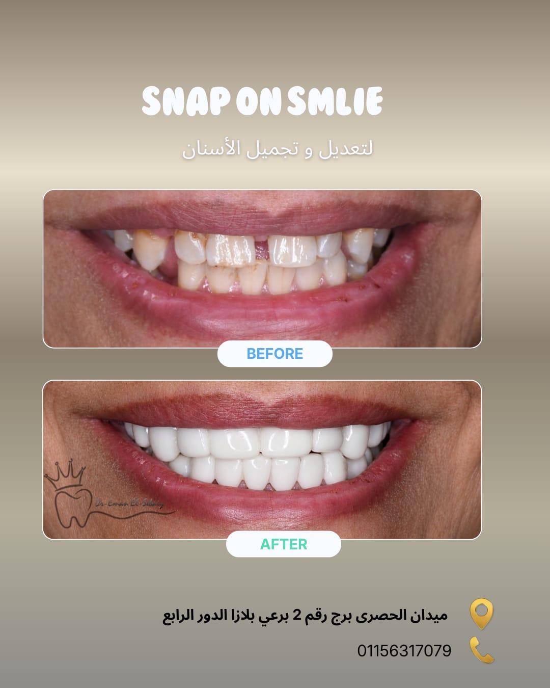 Snap On Smile