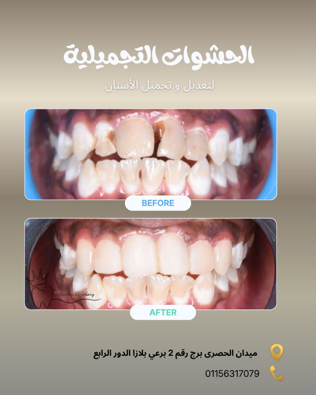 حشوات تجميلية