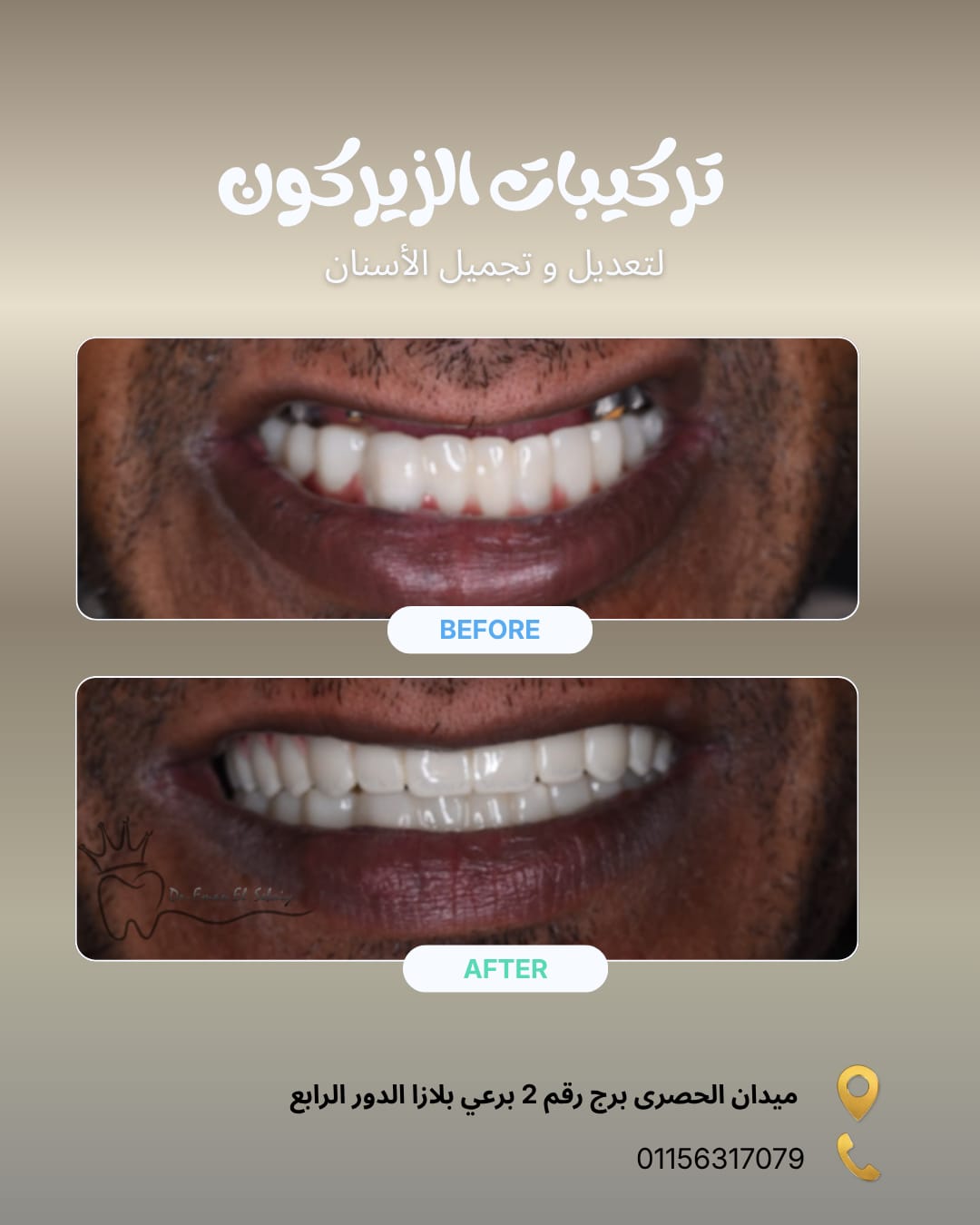 تركيبات الزيركون